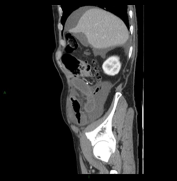Closed loop small bowel obstruction with ischemia (Radiopaedia 84180-99456 C 22).jpg