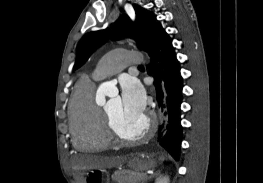 Coarctation of aorta with aortic valve stenosis (Radiopaedia 70463-80574 B 94).jpg