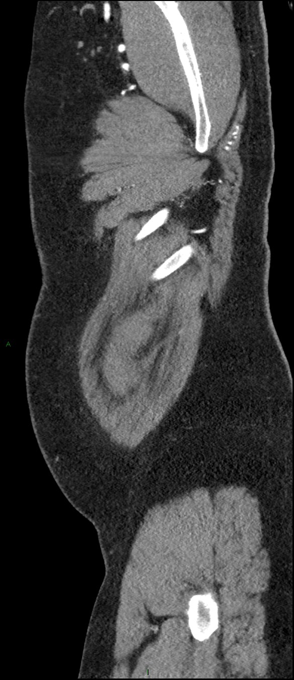 Coarctation of the aorta (Radiopaedia 74632-88521 C 5).jpg