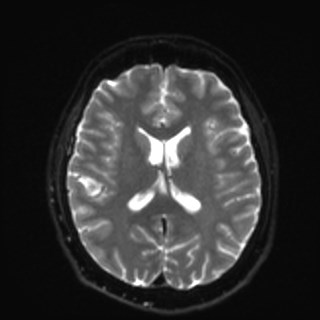 Cochlear incomplete partition type III associated with hypothalamic hamartoma (Radiopaedia 88756-105498 Axial DWI 24).jpg