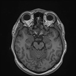 Cochlear incomplete partition type III associated with hypothalamic hamartoma (Radiopaedia 88756-105498 Axial T1 83).jpg