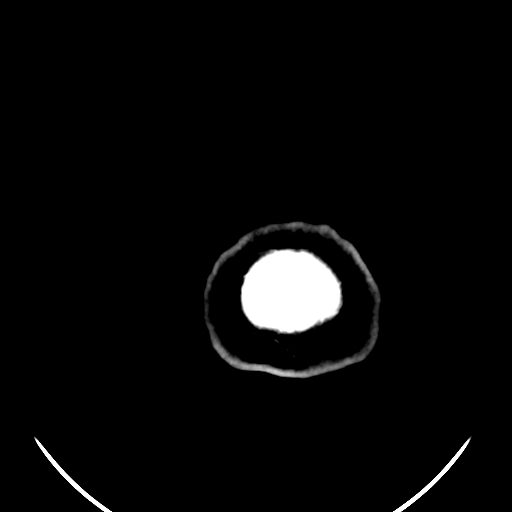 Colloid cyst (Radiopaedia 52865-58792 Axial non-contrast 2).jpg