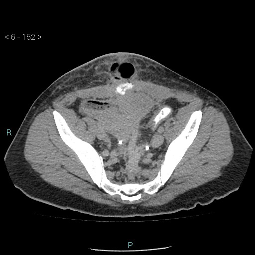 File:Colo-cutaneous fistula (Radiopaedia 40531-43129 A 63).jpg
