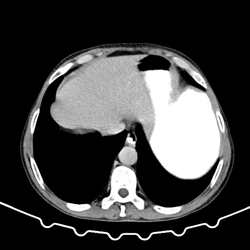 File:Colocolic intussusception due to large lipoma (Radiopaedia 68773-78482 A 12).jpg