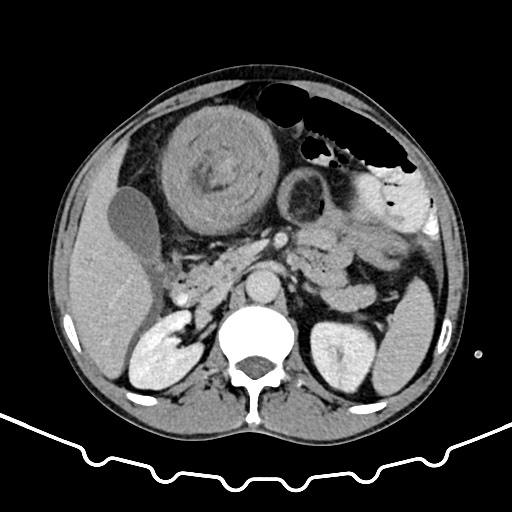 File:Colocolic intussusception due to large lipoma (Radiopaedia 68773-78482 A 60).jpg