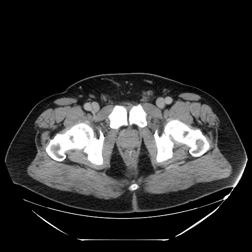 Colocolic intussusception due to lipoma (Radiopaedia 73712-84508 A 116).jpg