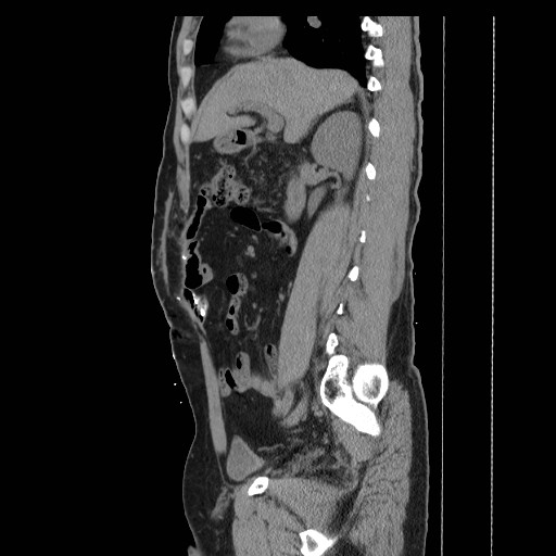 File:Colocutaneous fistula in Crohn's disease (Radiopaedia 29586-30093 F 5).jpg