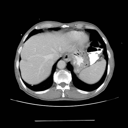File:Colon cancer with calcified liver metastasis (Radiopaedia 74423-85307 A 13).jpg
