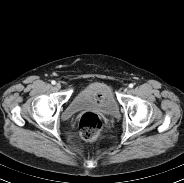 Colon carcinoma with hepatic metastases (Radiopaedia 29477-29961 A 109).jpg