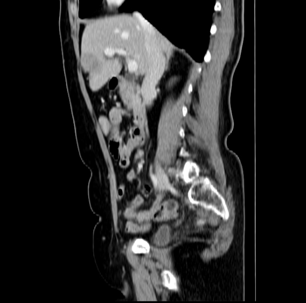 Colon carcinoma with hepatic metastases (Radiopaedia 29477-29961 C 22).jpg