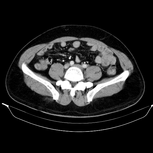Colonic lipoma with colo-colic intussusception (Radiopaedia 58944-66200 A 45).jpg
