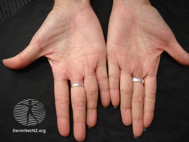 File:Ichthyosis vulgaris (DermNet NZ scaly-ich-vulg-palms).jpg