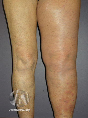 File:Metastatic melanoma (DermNet NZ lesions-metastatic-melanoma07).jpg