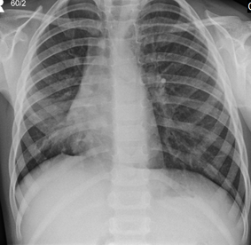 File:Middle lobe collapse from foreign body inhalation (Radiopaedia 21342).png