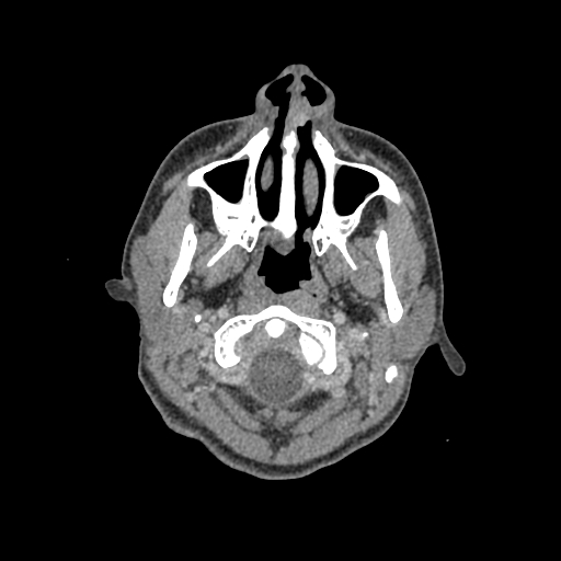 File:Nasal pyogenic granuloma (lobular capillary hemangioma) (Radiopaedia 85536-101244 C 13).jpg