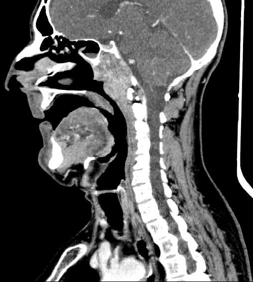 File:Nasopharyngeal carcinoma - infiltrating the clivus (Radiopaedia 62583-70875 C 29).jpg