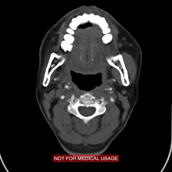 File:Nasopharyngeal carcinoma recurrence - skull base destruction (Radiopaedia 29107-29491 A 18).jpg