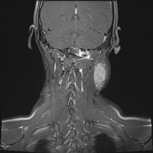 Nasopharyngeal carcinoma with skull base invasion (Radiopaedia 53415-59485 E 4).jpg