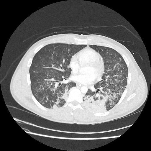 Near-drowning pulmonary edema (Radiopaedia 59457-66814 Axial lung window 34).jpg