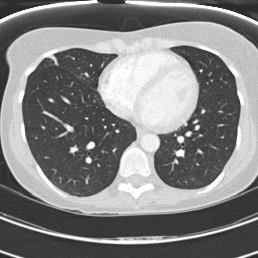 Necrobiotic pulmonary nodules - Crohn disease (Radiopaedia 20723-20631 Axial lung window 95).jpg
