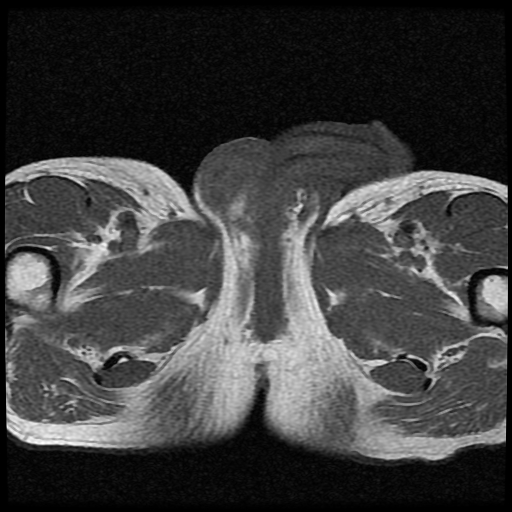File:Necrotizing epididymo-orchitis with intra-testicular abscess (Radiopaedia 29397-29860 Axial T1 11).jpg