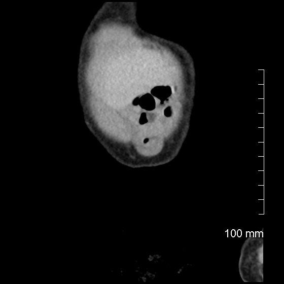 File:Neonatal neuroblastoma (Radiopaedia 56651-63438 Coronal non-contrast 5).jpg