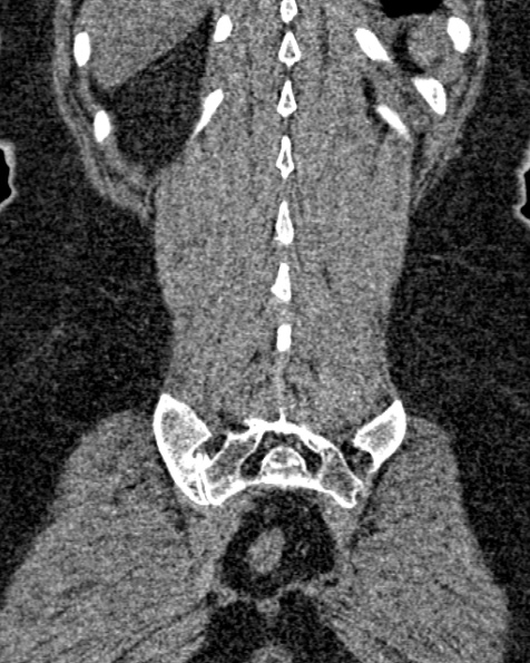 File:Nephrostomy for urosepsis (Radiopaedia 26180-26330 non-contrast 75).jpg