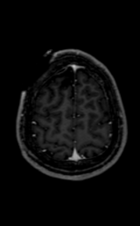 Neuro-Behçet disease (Radiopaedia 90112-107294 Axial T1 C+ 69).jpg