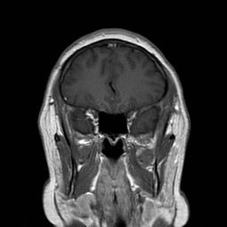 File:Neuro-Behcet's disease (Radiopaedia 21557-21505 Coronal T1 C+ 4).jpg