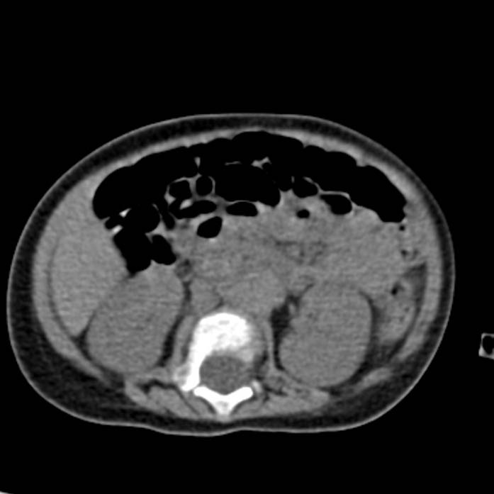 Neuroblastoma with skull metastases (Radiopaedia 30326-30960 Axial non-contrast 30).jpg