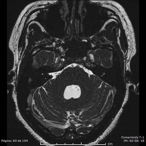 Neurocysticercosis (Radiopaedia 58636-65832 I 60).jpg
