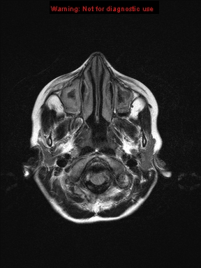File:Neurofibromatosis type 1 with optic nerve glioma (Radiopaedia 16288-15965 Axial FLAIR 23).jpg