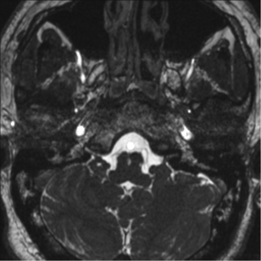 Neurofibromatosis type 2 (Radiopaedia 44936-48838 E 15).png