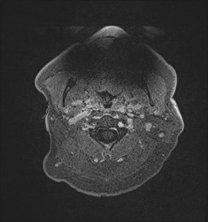 Neurofibromatosis type 2 (Radiopaedia 79097-92049 Axial T1 C+ 1).jpg
