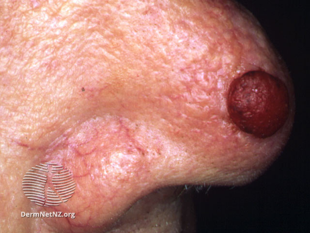 File:Nodular melanoma (DermNet NZ mel2).jpg
