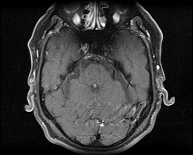 File:Non-Hodgkin lymphoma - parotid gland (Radiopaedia 71531-81890 Axial T1 C+ fat sat 24).jpg
