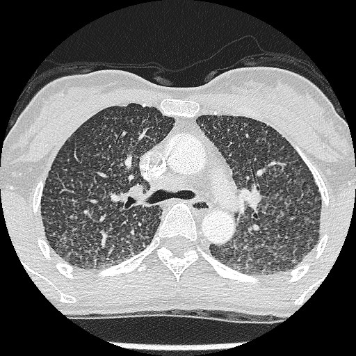 File:Non-small cell lung cancer with miliary metastases (Radiopaedia 23995-24193 Axial lung window 10).jpg
