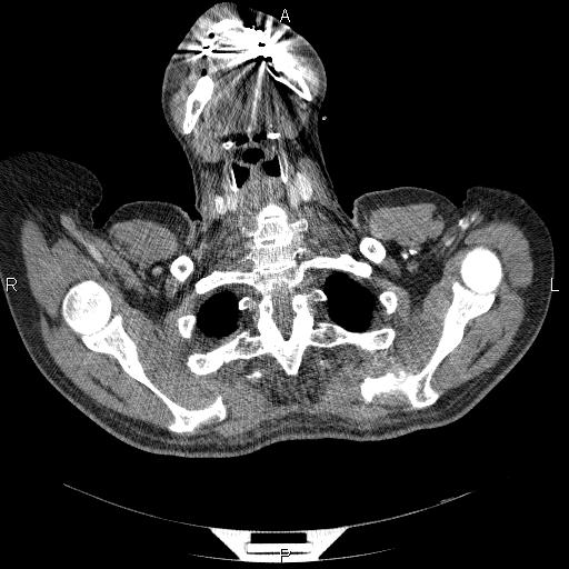 File:Non Hodgkin lymphoma in a patient with ankylosing spondylitis (Radiopaedia 84323-99624 B 3).jpg