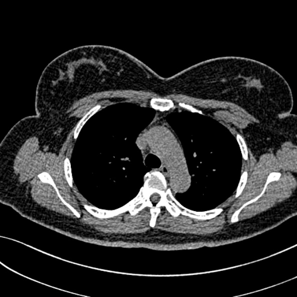 Normal CT chest- adult female (Radiopaedia 52522-58428 Axial non-contrast 43).jpg
