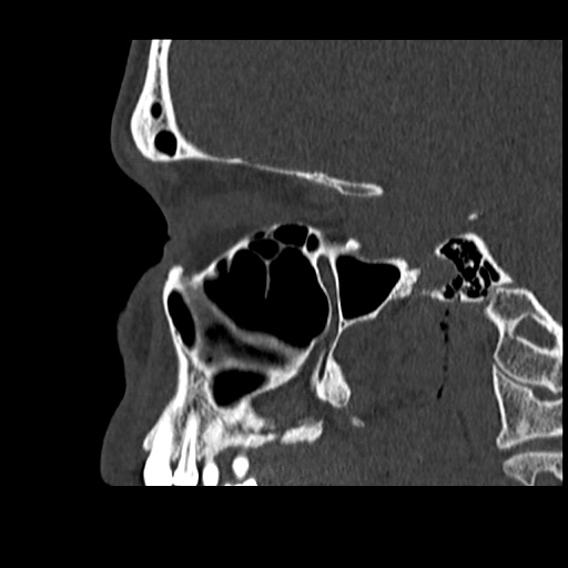Normal CT paranasal sinuses (Radiopaedia 42286-45390 Sagittal bone window 34).jpg