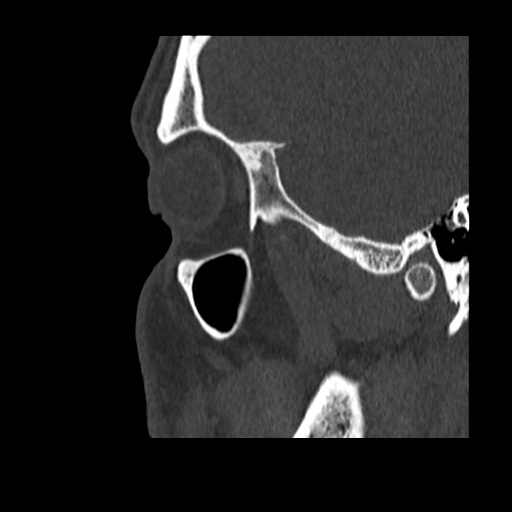 Normal CT paranasal sinuses (Radiopaedia 42286-45390 Sagittal bone window 89).jpg