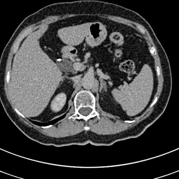 File:Normal CT split bolus study of the renal tract (Radiopaedia 48631-53634 Axial split bolus 25).jpg