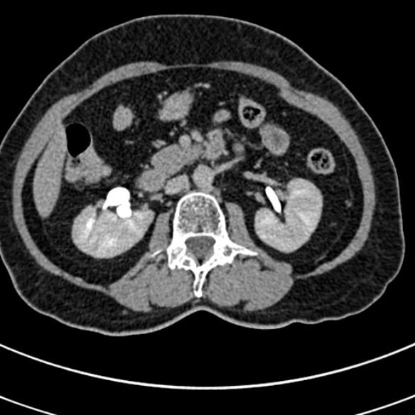 File:Normal CT split bolus study of the renal tract (Radiopaedia 48631-53634 Axial split bolus 85).jpg