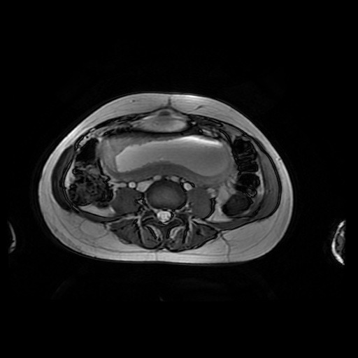 File:Normal MRI abdomen in pregnancy (Radiopaedia 88001-104541 Axial Gradient Echo 32).jpg