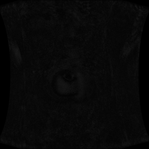 Normal MRI abdomen in pregnancy (Radiopaedia 88001-104541 N 6).jpg