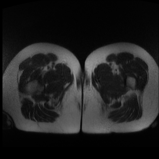 Normal MRI abdomen in pregnancy (Radiopaedia 88003-104546 Axial T2 58).jpg