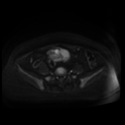 Normal MRI abdomen in pregnancy (Radiopaedia 88005-104548 Axial DWI 102).jpg