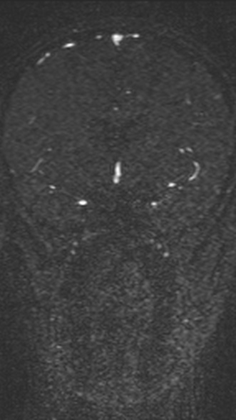 Normal MRI brain with MRV- teenager (Radiopaedia 49425-54553 Coronal MRV 102).jpg