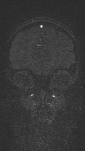 Normal MRI brain with MRV- teenager (Radiopaedia 49425-54553 Coronal MRV 61).jpg