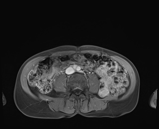Normal adrenal glands MRI (Radiopaedia 82017-96004 M 65).jpg